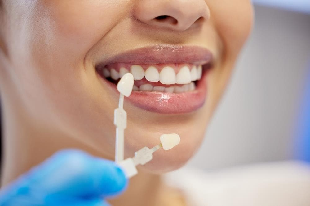 ¿Cuáles son los beneficios de un blanqueamiento dental profesional?