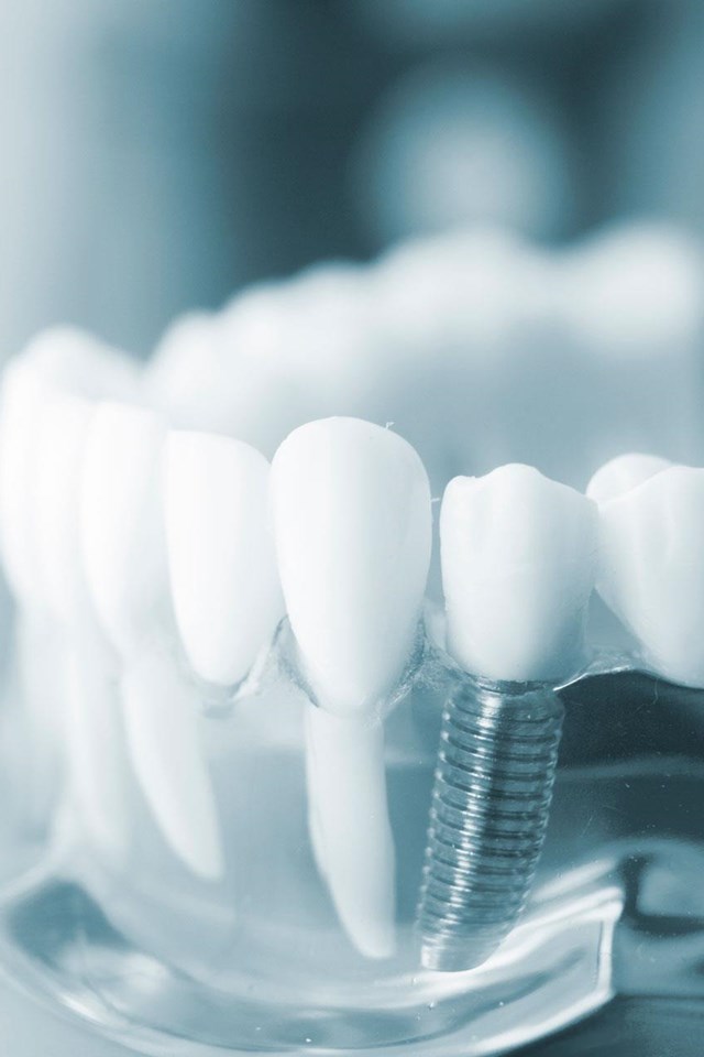 Especialistas en implantes dentais en Cangas