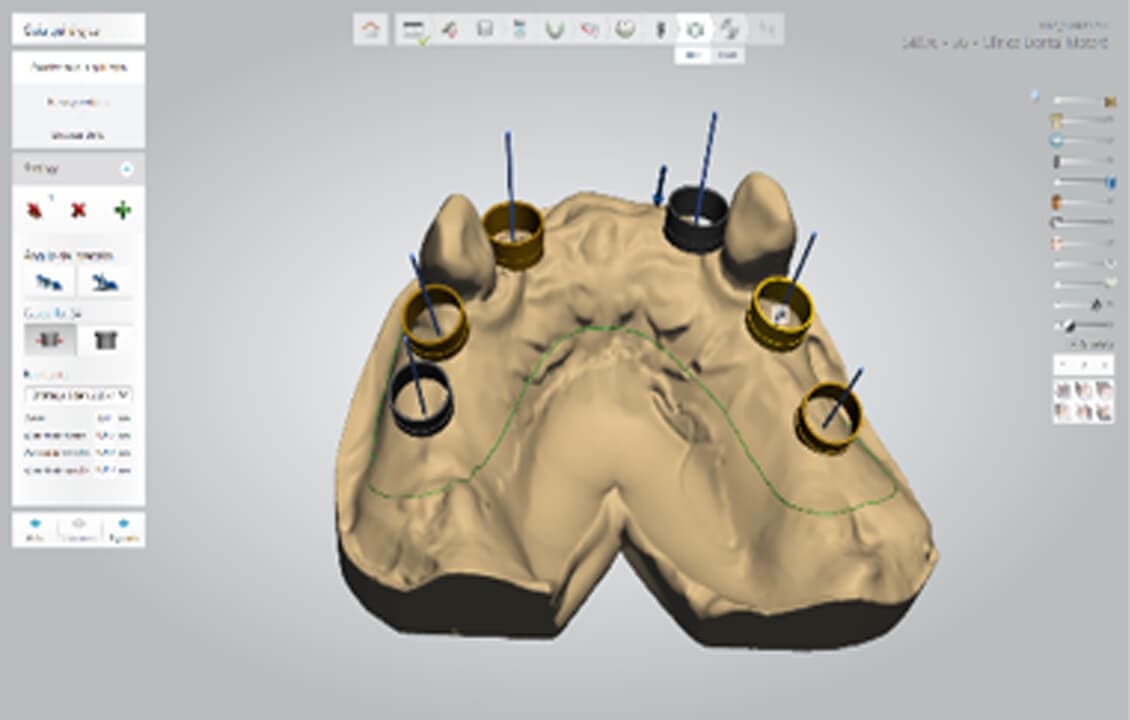 Cirurxía guida de implantes por computador en Cangas