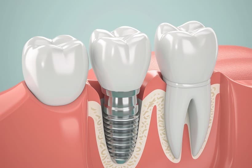 Implantes en Cangas