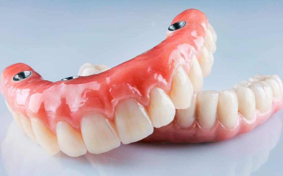 Implantología dental en Cangas