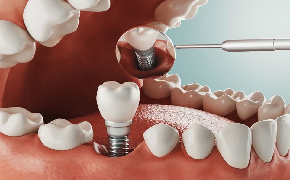 Implantólogo en Cangas