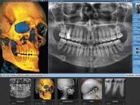 ¿Qué es un TAC Digital Dental Radiodiagnóstico 3D (Escáner CBCT) y cómo puede ayudar en los tratamientos odontológicos?