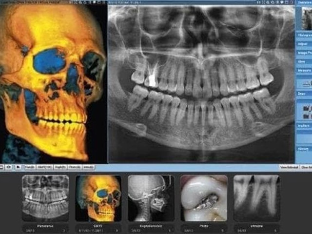 ¿Qué es un TAC Digital Dental Radiodiagnóstico 3D (Escáner CBCT) y cómo puede ayudar en los tratamientos odontológicos?